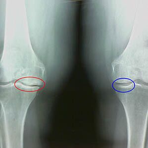 Arthrose de l'articulation du genou sur la radiographie